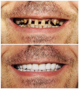 Before and after dental implants - complete smile restoration case