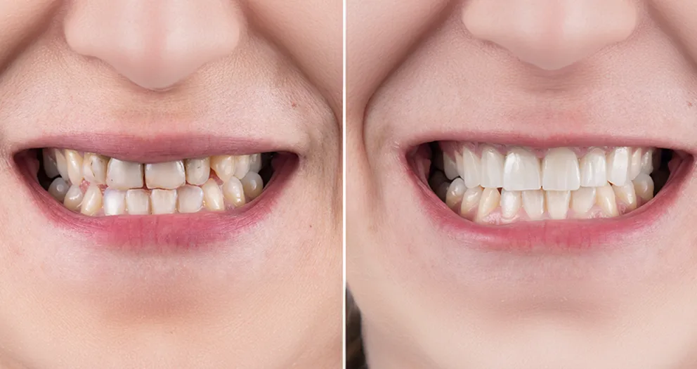 Before and after porcelain veneers - smile makeover with ceramic veneers